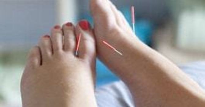 Acupuncture for Neuropathy: A Natural Path to Pain Relief image