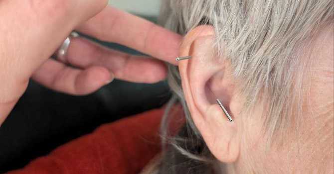 Acupuncture for Stress and Trauma: A Holistic Path to Healing image